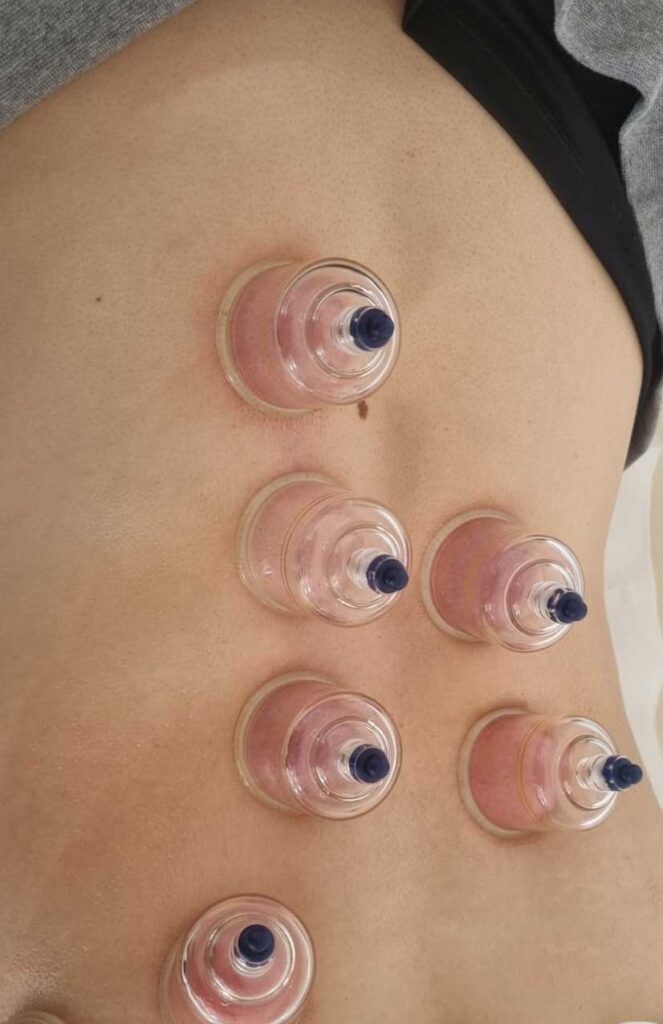 cupping terapija postura